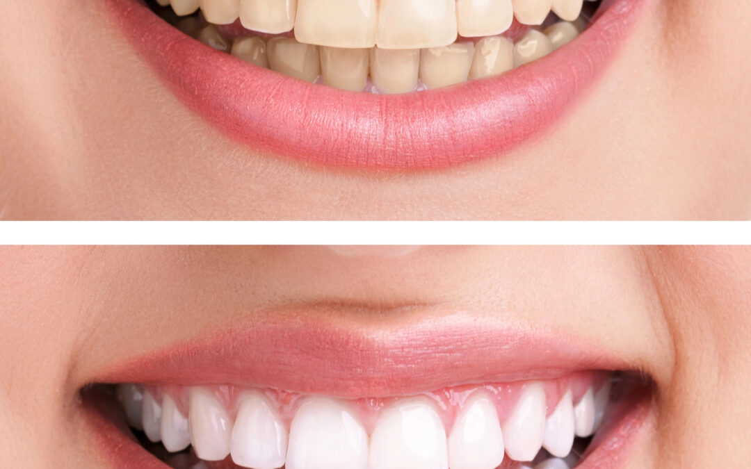 DIY vs Professional Teeth Whitening: What Australians Need to Know
